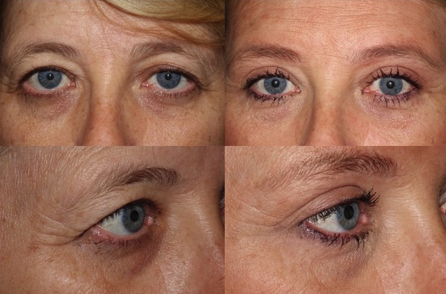 browlift-for-droopy-eyelids-north-york-cosmetic-clinic