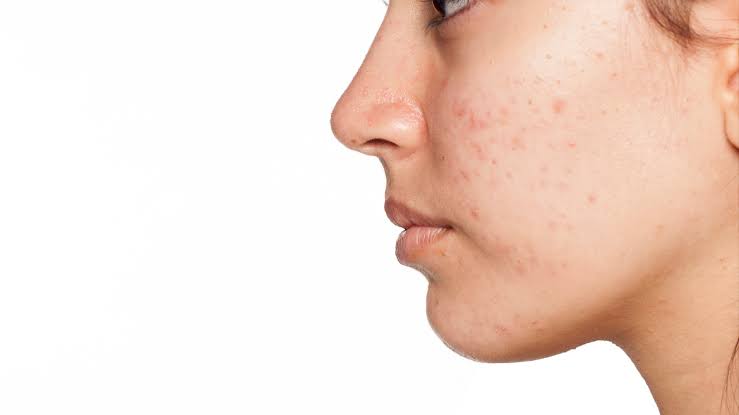 Laser/light Therapy for Skin Lesions | North York Cosmetic Clinic