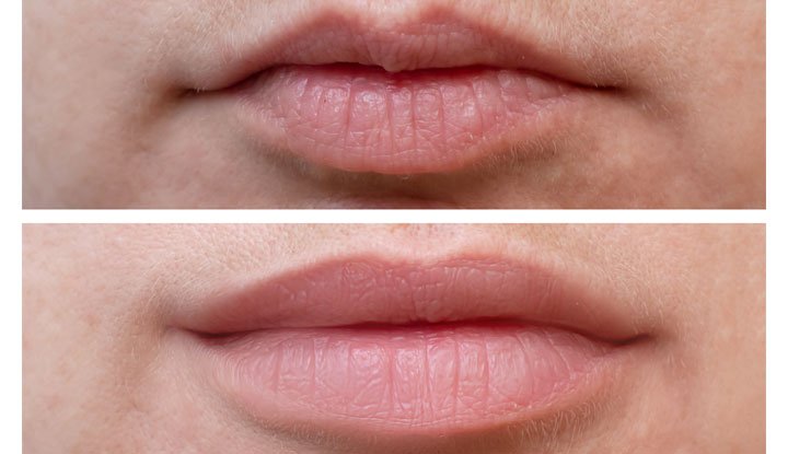 everything-about-lip-flip-with-botox-north-york-cosmetic-clinic