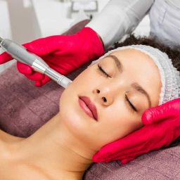 Benefits of Microneedling in North York