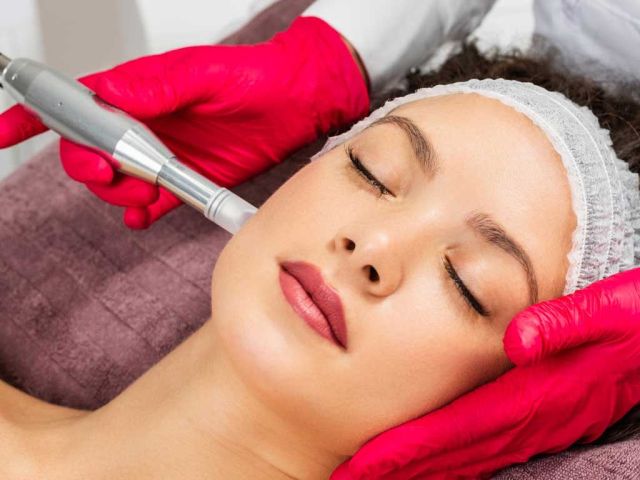 Benefits of Microneedling in North York