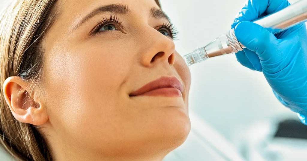 Microneedling Reduces Wrinkles