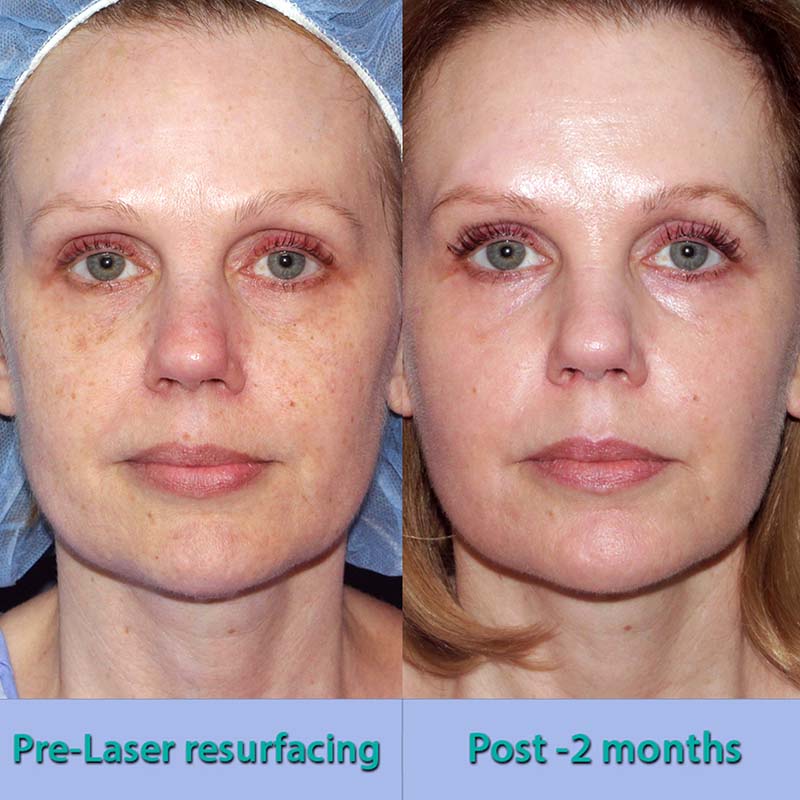 GROFF-laser-resurfacing